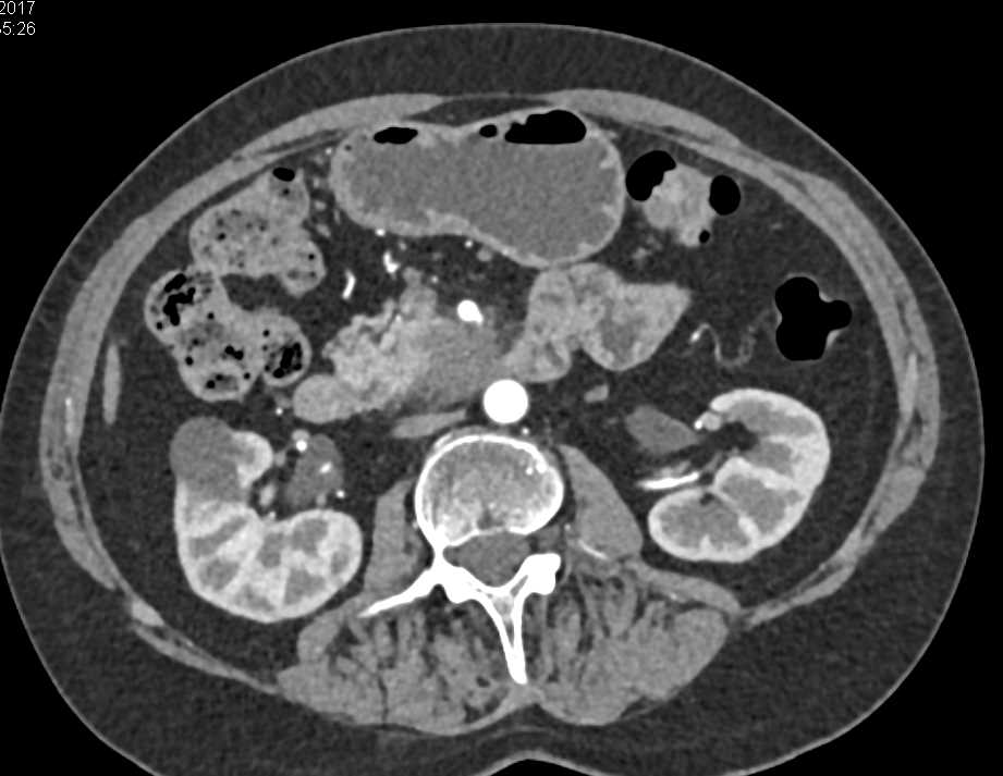 Adenocarcinoma Uncinate Process Invades the Duodenum - CTisus CT Scan