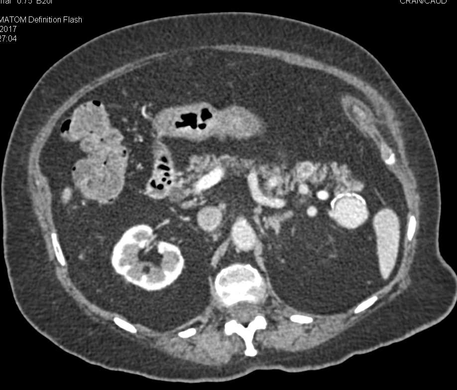 Pancreatic Neuroendocrine Tumor (PNET) Tail of Pancreas and Splenule Near the tail of the Pancreas - CTisus CT Scan