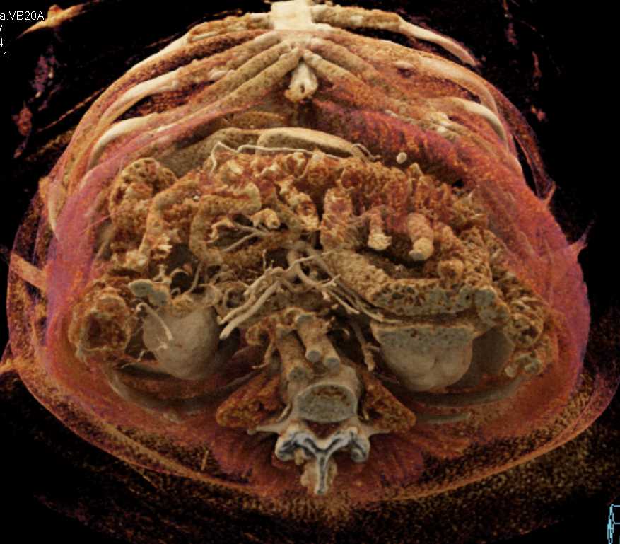 Carcinoma Head of Pancreas with Arterial and Venous Encasement - CTisus CT Scan