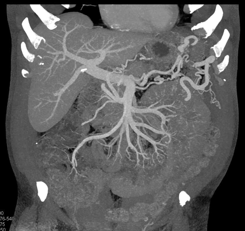 Carcinoma Tail of Pancreas with Vascular Involvement - CTisus CT Scan