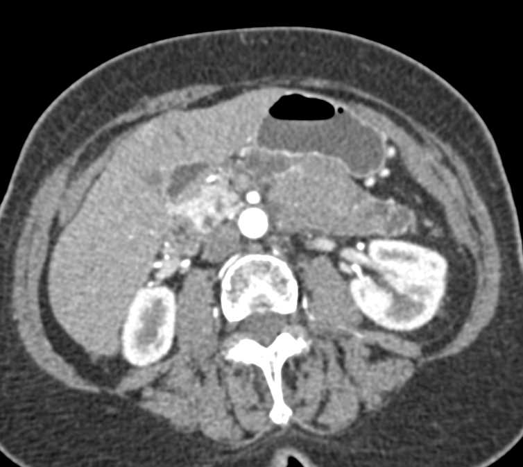Carcinoma Body of Pancreas Obstructs the Pancreatic Duct - CTisus CT Scan
