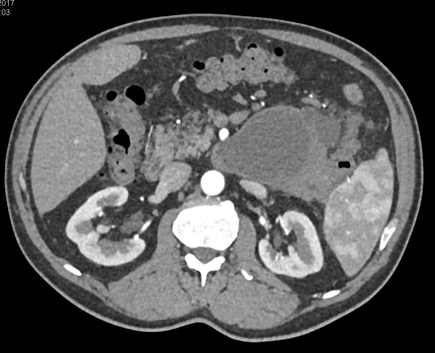 Pancreatitis with Pseudocyst - Pancreas Case Studies - CTisus CT Scanning