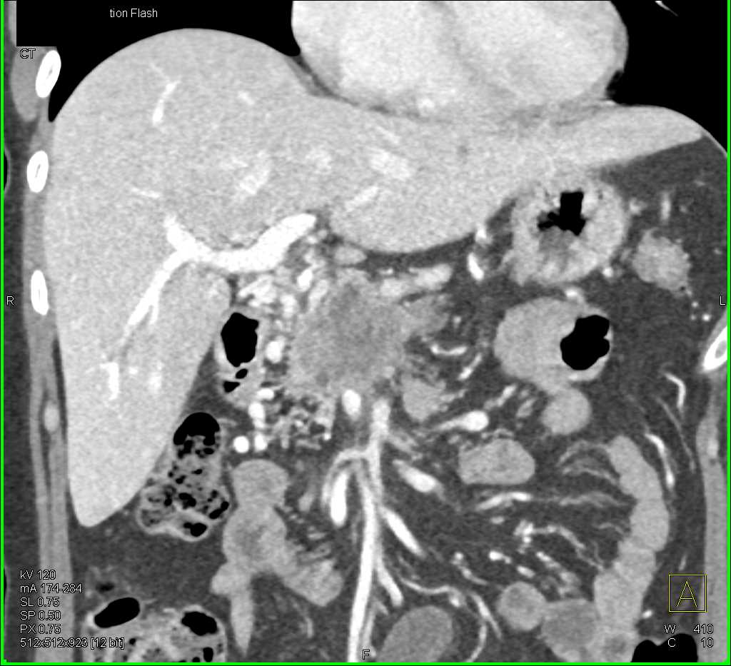 Invasive Carcinoma Head of Pancreas - CTisus CT Scan