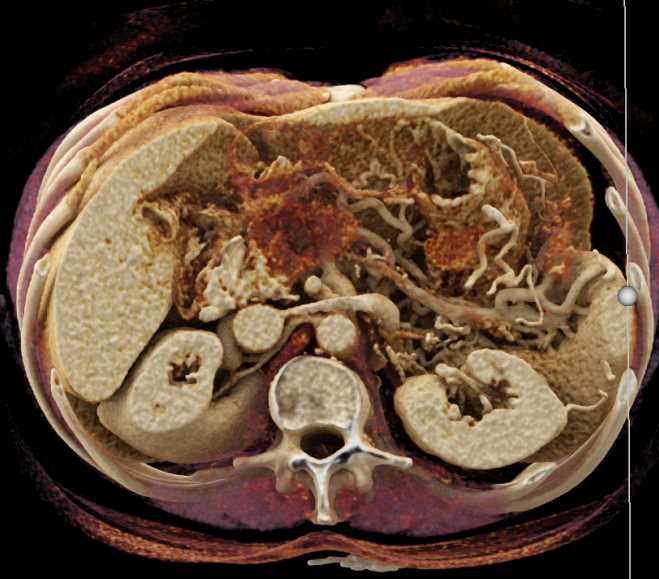 Pancreas Cancer with Cinematic Rendering - CTisus CT Scan