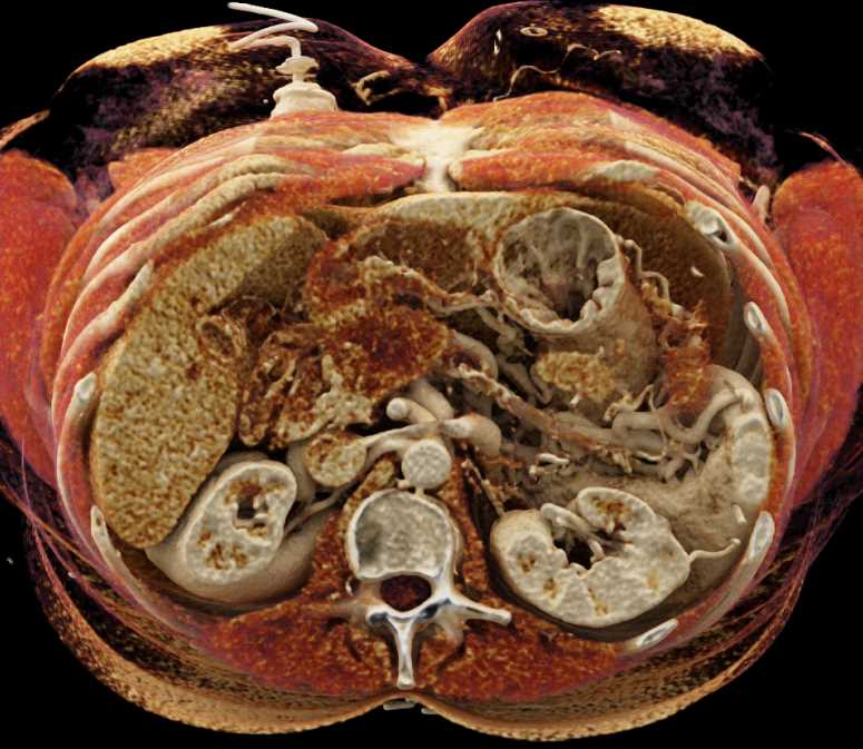Pancreas Cancer with Cinematic Rendering - CTisus CT Scan