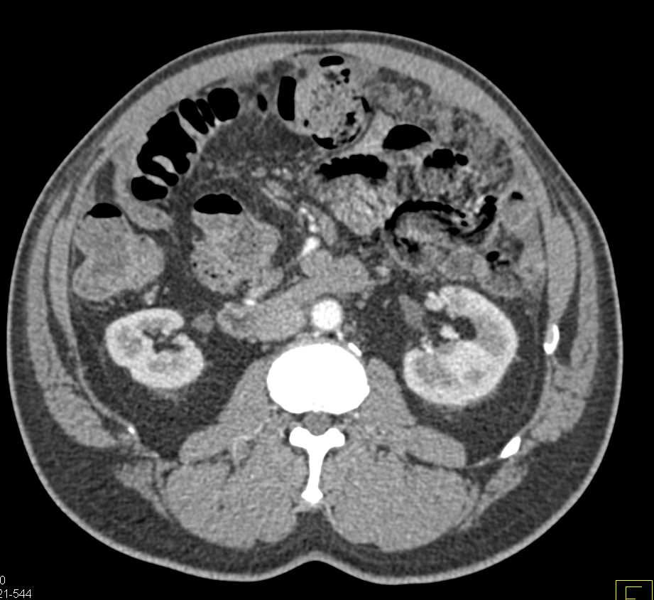 Carcinomatosis due to Carcinoma Tail of Pancreas - CTisus CT Scan