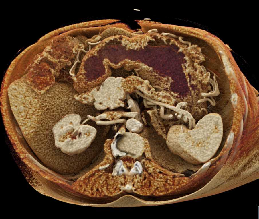 Carcinoma of the Body of the Pancreas - CTisus CT Scan