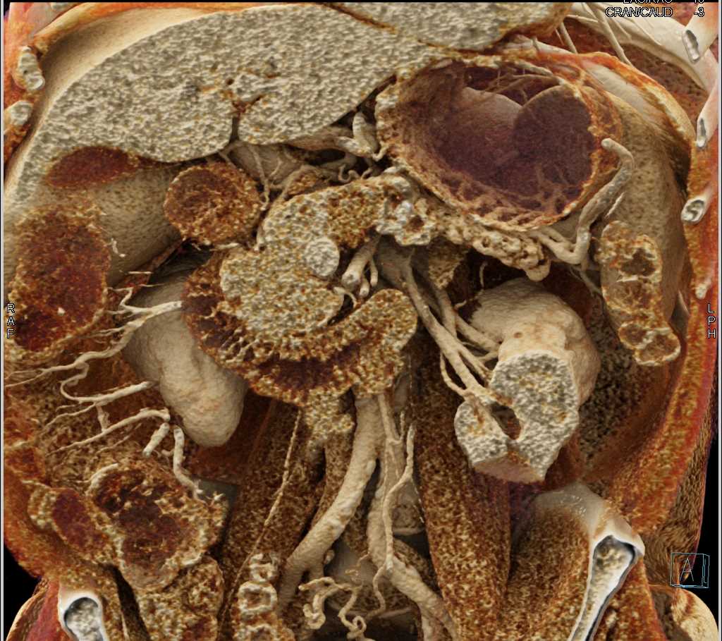 Carcinoma of the Body of the Pancreas - CTisus CT Scan