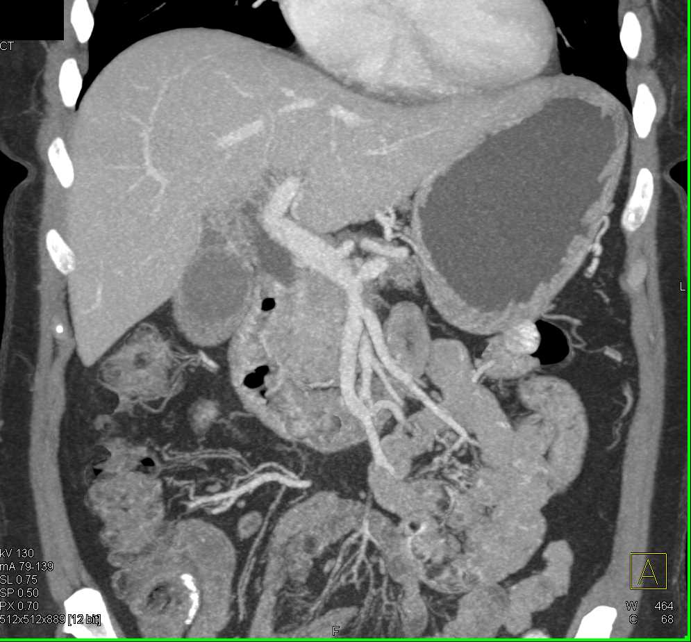 Pancreatic Adenocarcinoma Obstructs the Pancreatic Duct - CTisus CT Scan