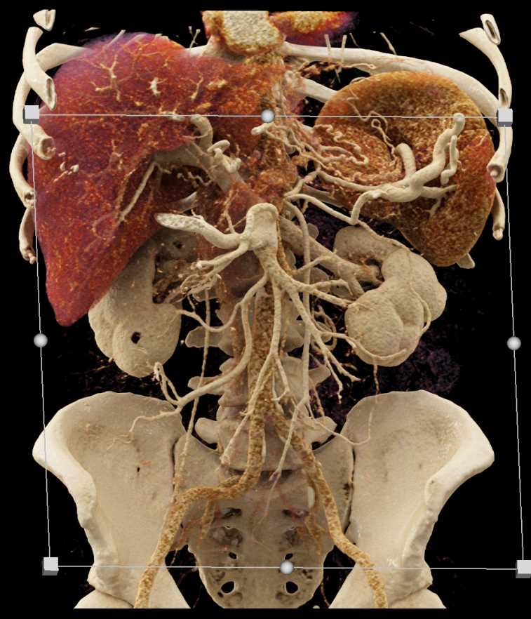 Pancreas Adenocarcinoma - CTisus CT Scan