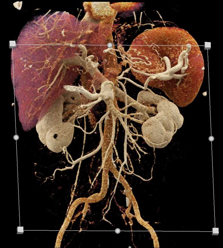 Pancreas Adenocarcinoma - CTisus CT Scan