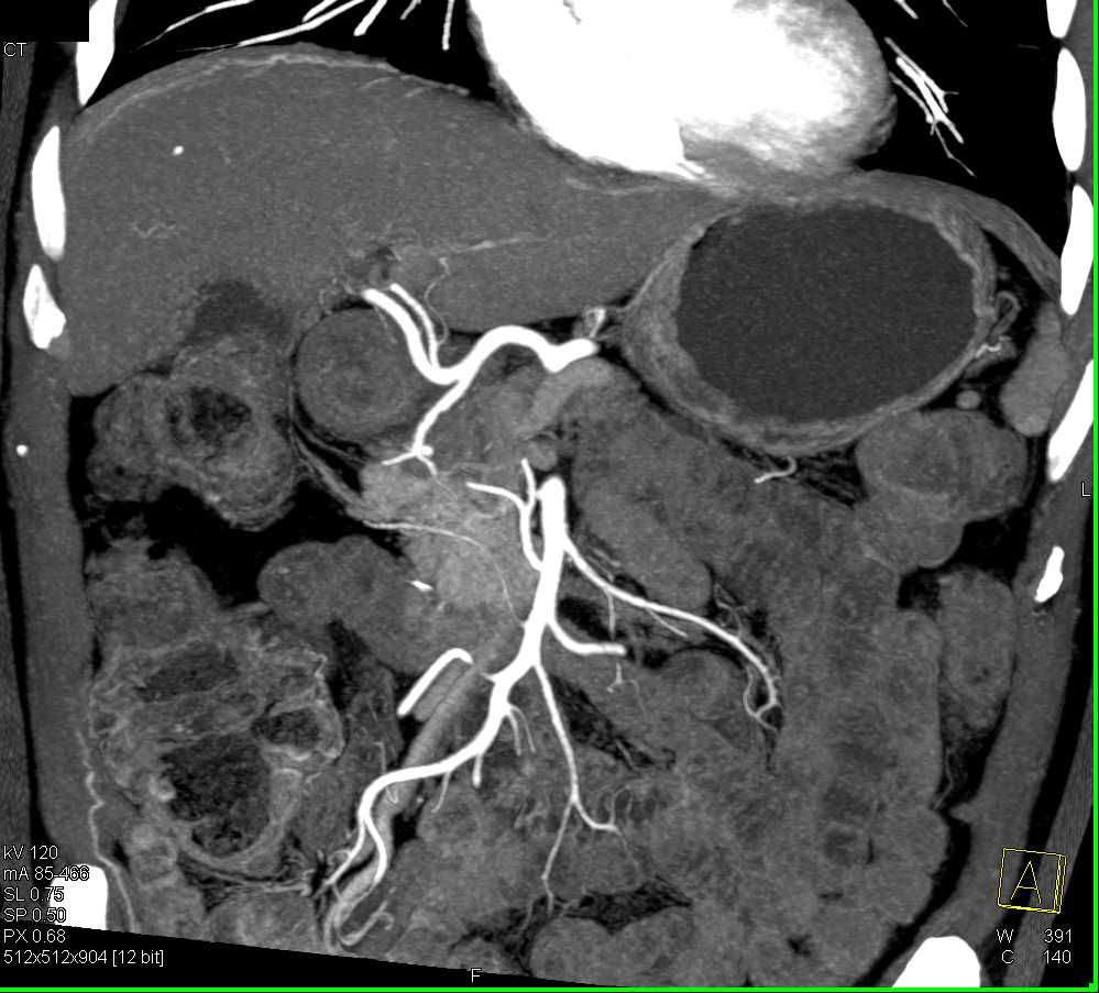 Adenocarcinoma Head of Pancreas - CTisus CT Scan