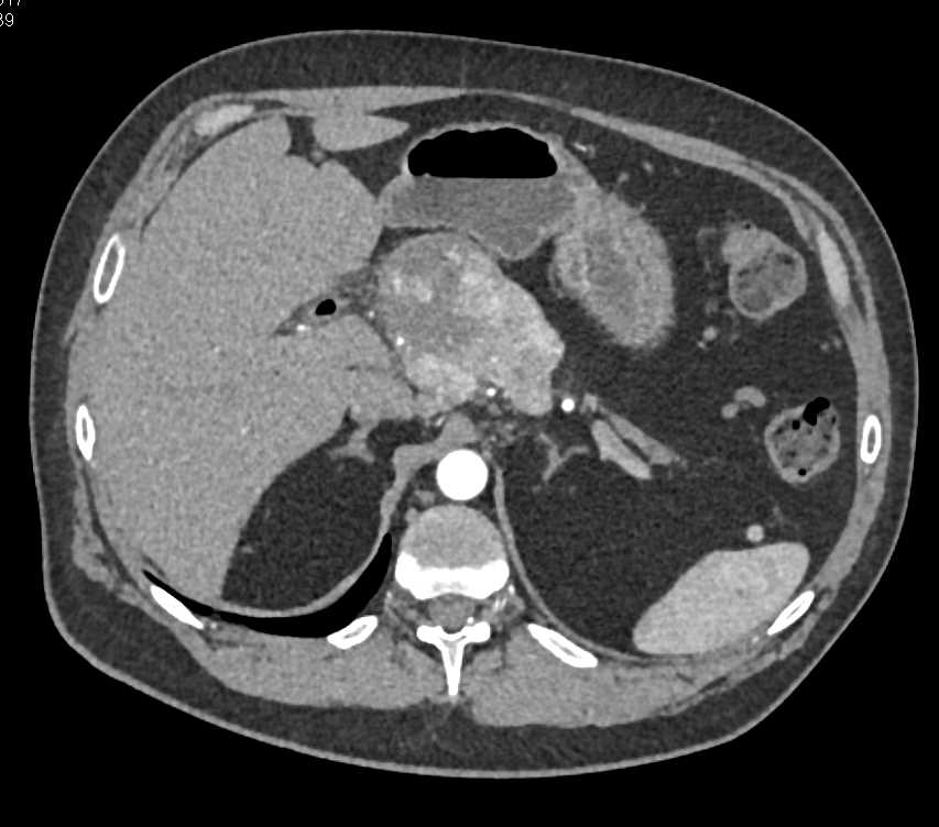 Neuroendocrine Tumor Pancreas with Arterial and Venous Involvement - CTisus CT Scan