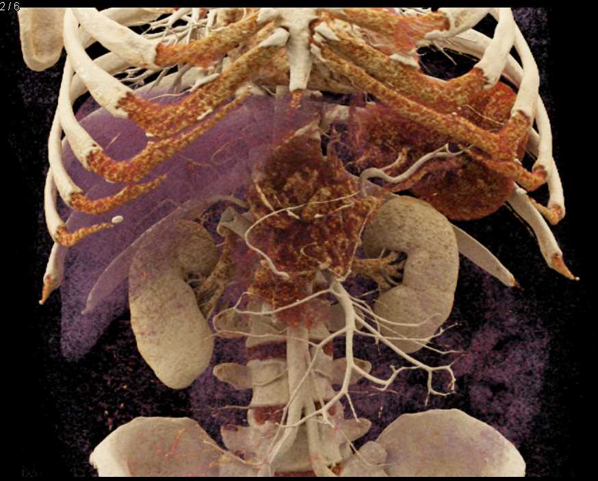 Neuroendocrine Tumor Pancreas with Arterial and Venous Involvement with Cinematic Rendering - CTisus CT Scan