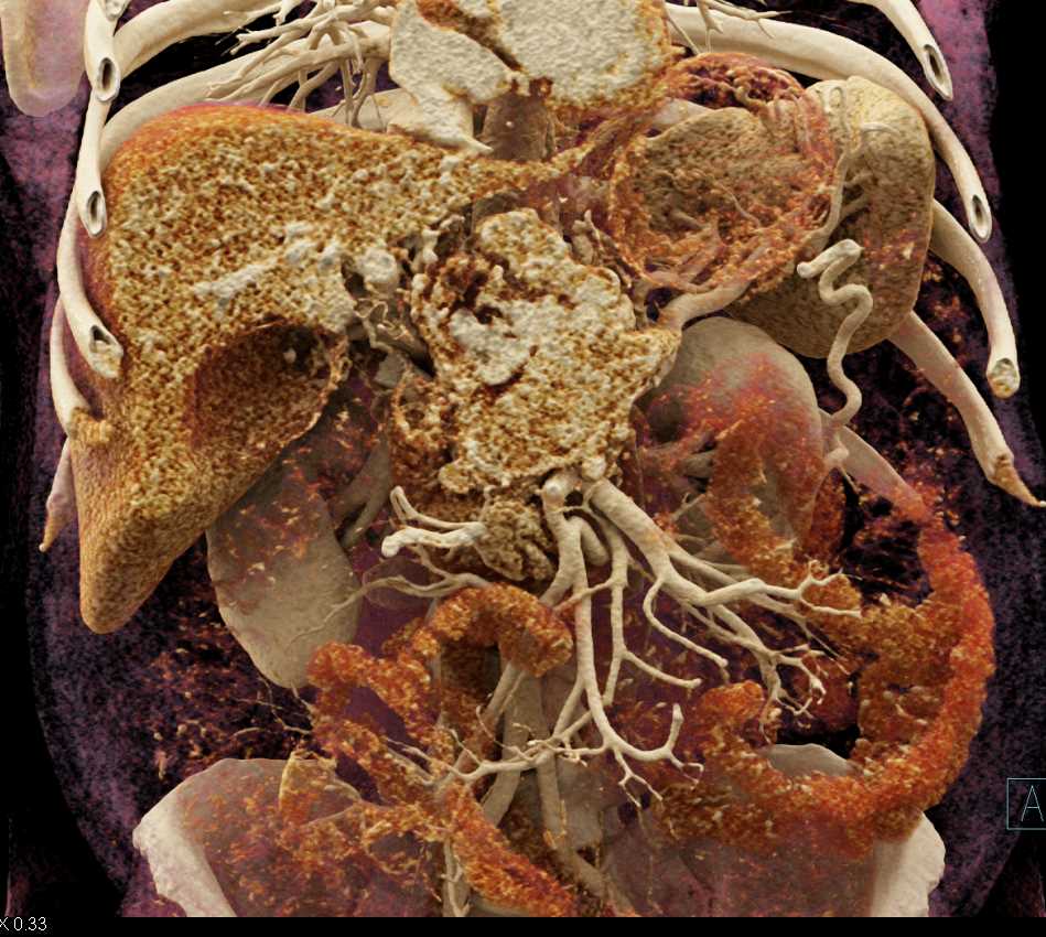 Pancreatic Adenocarcinoma - CTisus CT Scan