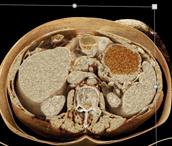Subtle Pancreatic Adenocarcinoma - CTisus CT Scan