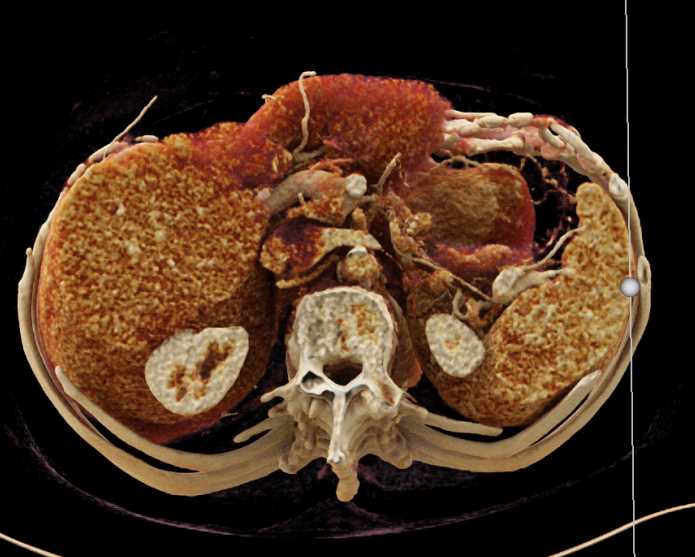 Subtle Pancreatic Adenocarcinoma - CTisus CT Scan