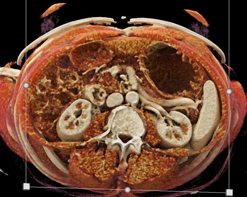 Carcinoma Body of Pancreas - CTisus CT Scan