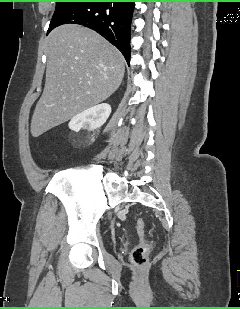 IPMN Tail of Pancreas and Incidental Right Renal AML - CTisus CT Scan