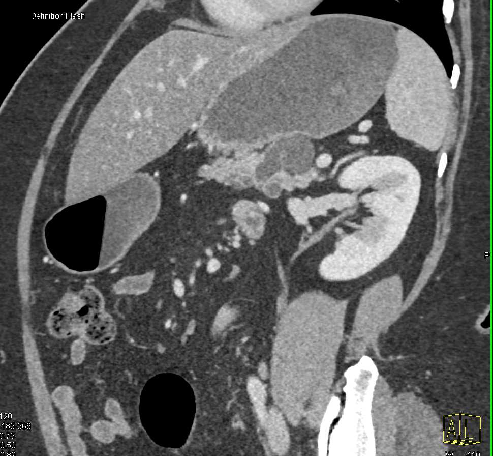 IPMN Tail of Pancreas and Incidental Right Renal AML - CTisus CT Scan