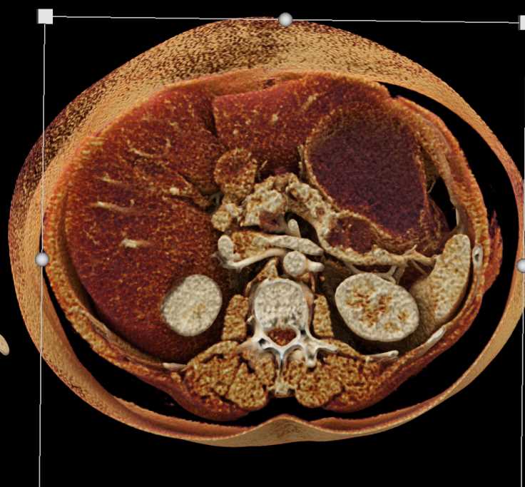 Mucinous Cystic Neoplasm (MCN) in the Tail of the Pancreas - CTisus CT Scan