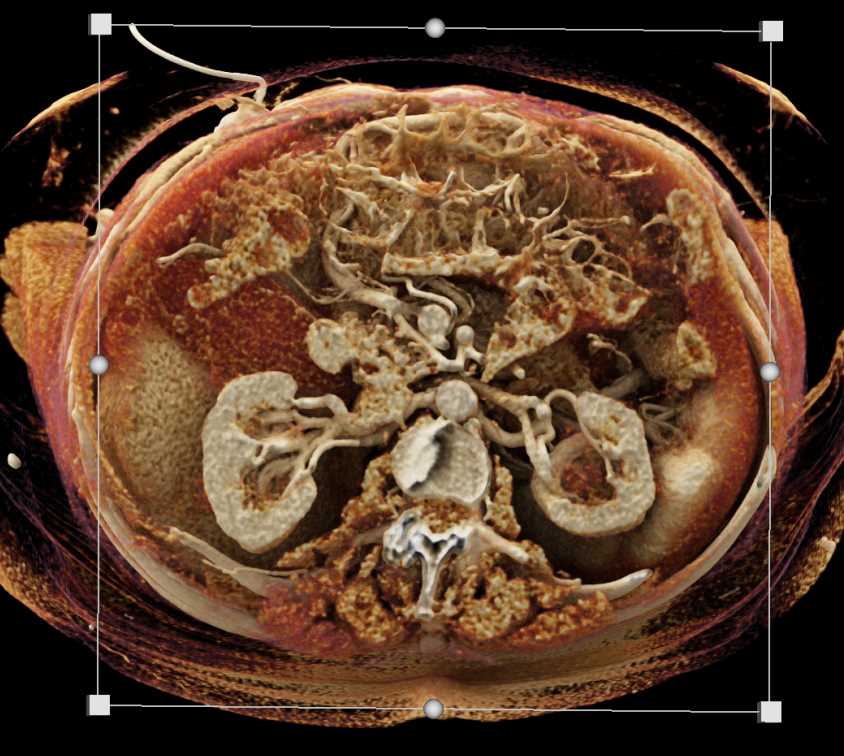 Pancreatic Cancer - CTisus CT Scan