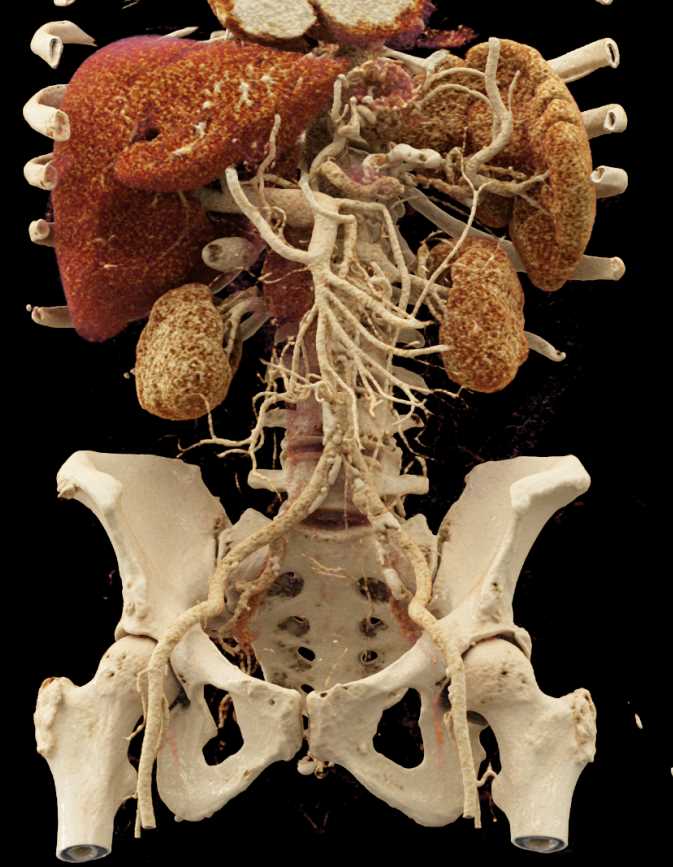 Carcinoma Tail of Pancreas - CTisus CT Scan