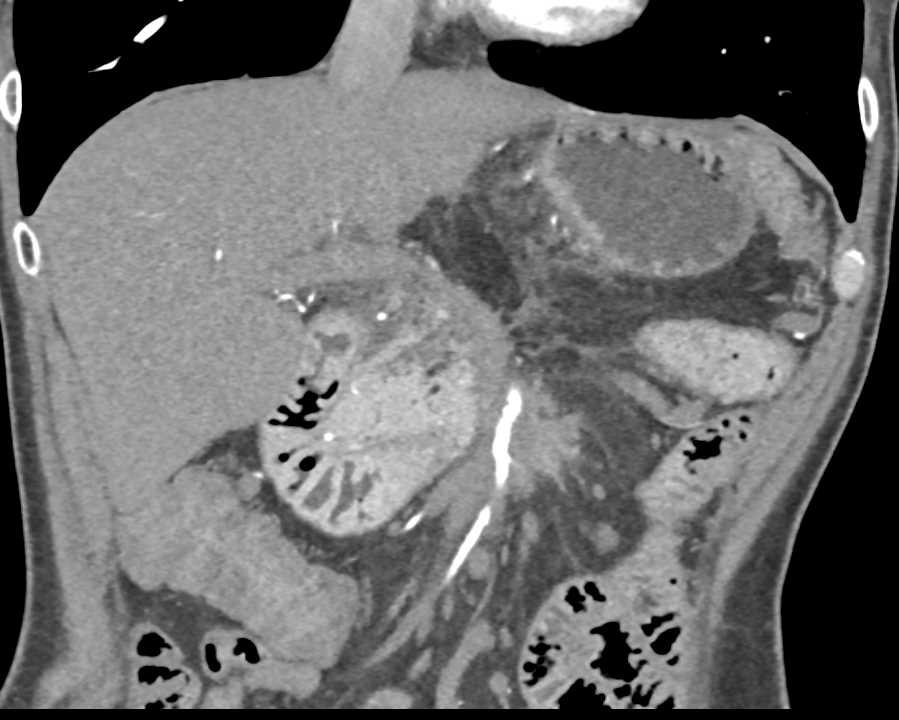 Infiltrating Pancreatic Adenocarcinoma - CTisus CT Scan