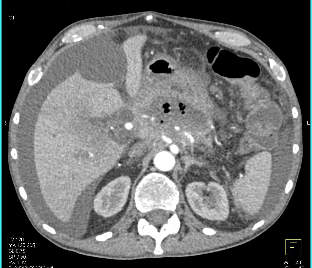 Pancreatic Adenocarcinoma Invades Vascular Map with Tumor Necrosis - CTisus CT Scan