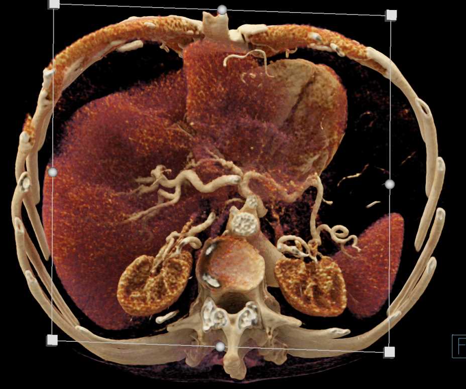 Pancreatic Cancer Encases the Celiac Artery - CTisus CT Scan