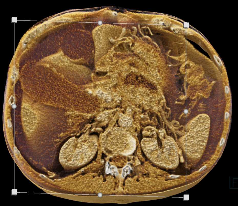 Pancreatic Cancer Encases the Celiac Artery - CTisus CT Scan