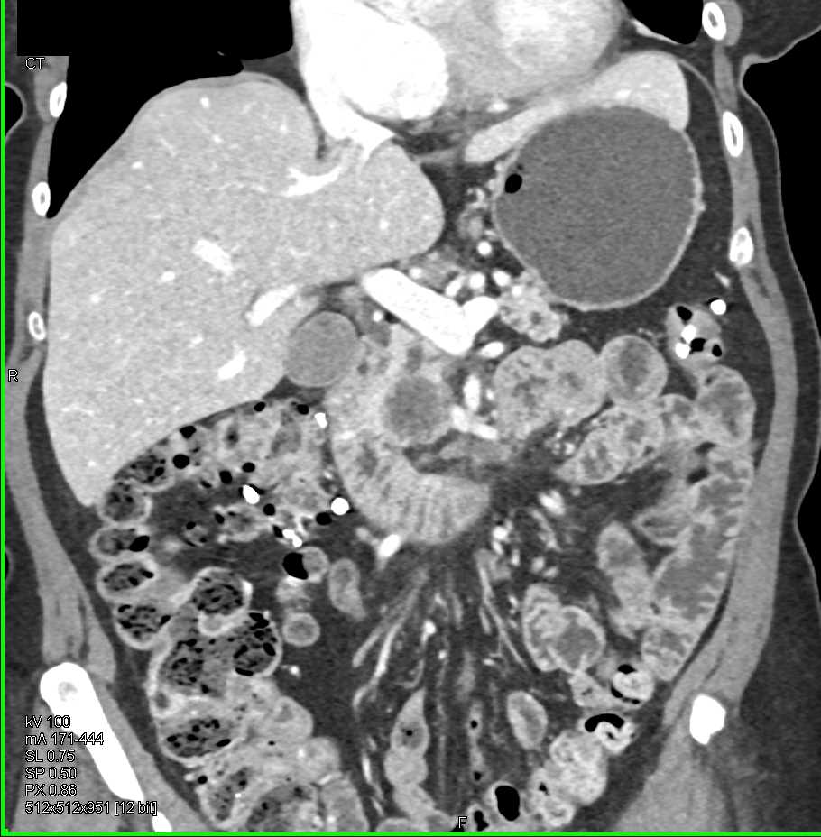 Invasive Carcinoma Head of Pancreas - CTisus CT Scan