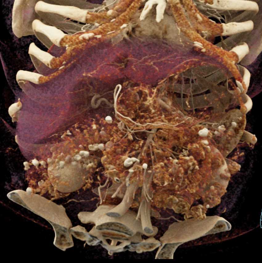 Invasive Carcinoma Head of Pancreas - CTisus CT Scan