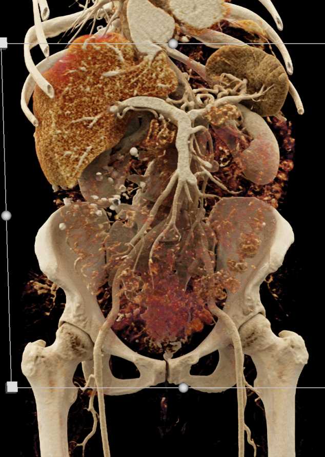 Invasive Carcinoma Head of Pancreas - CTisus CT Scan