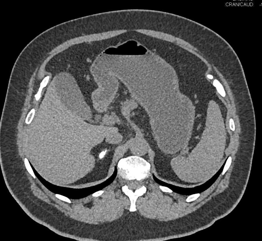 1cm Pancreatic Neuroendocrine Tumor (PNET) Cystic Type in the Tail of the Pancreas - CTisus CT Scan