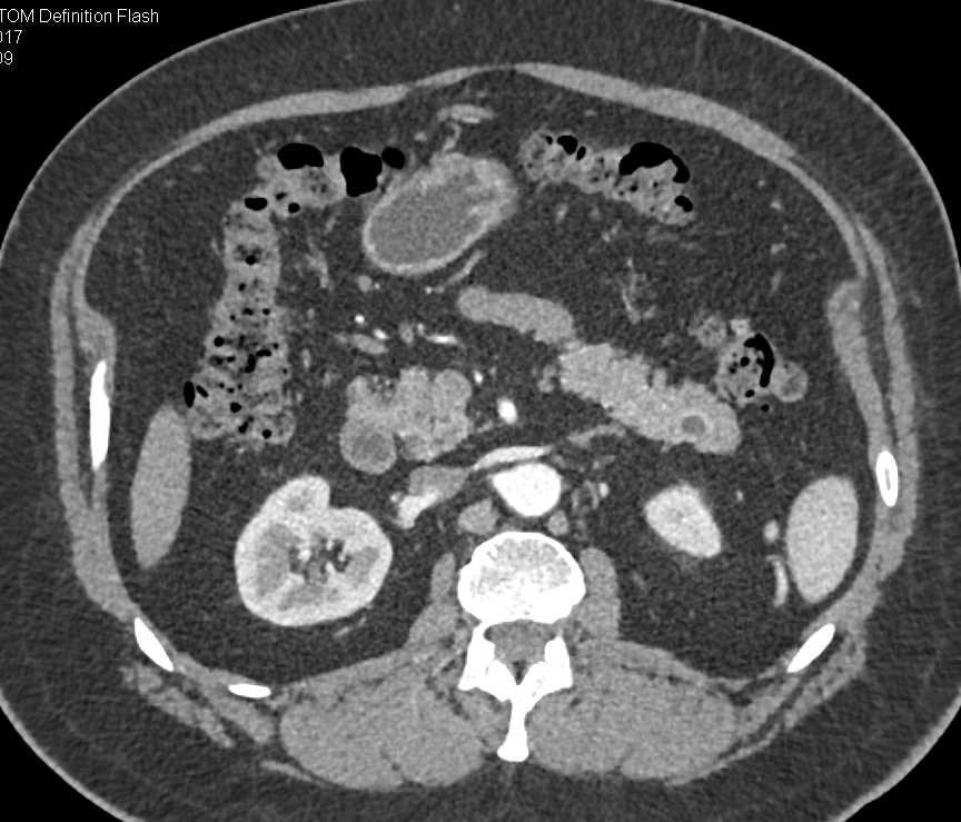 1cm Pancreatic Neuroendocrine Tumor (PNET) Cystic Type in the Tail of the Pancreas - CTisus CT Scan