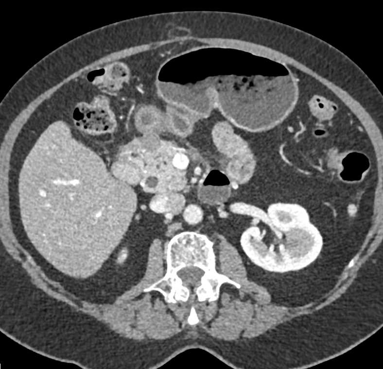 Pancreatic Neuroendocrine Tumor (PNET) of the Head of the Pancreas - CTisus CT Scan