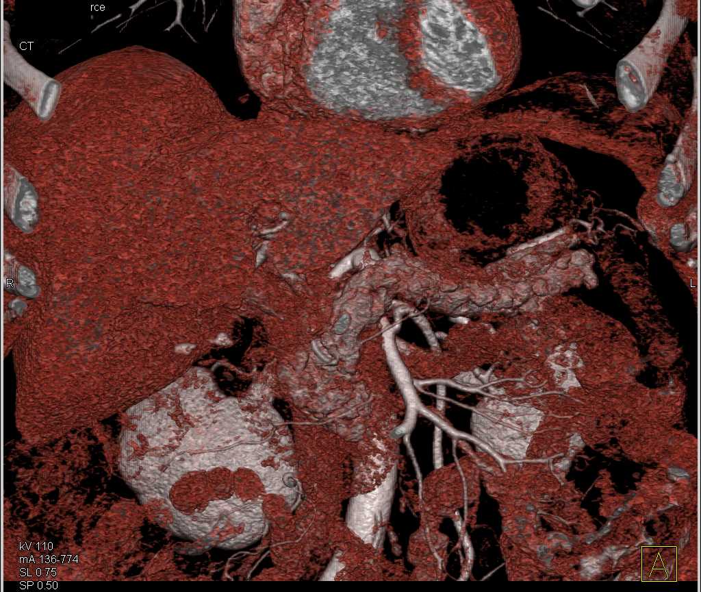 Incidental Pancreatic Neuroendocrine Tumor (PNET) in Tail of Pancreas - CTisus CT Scan