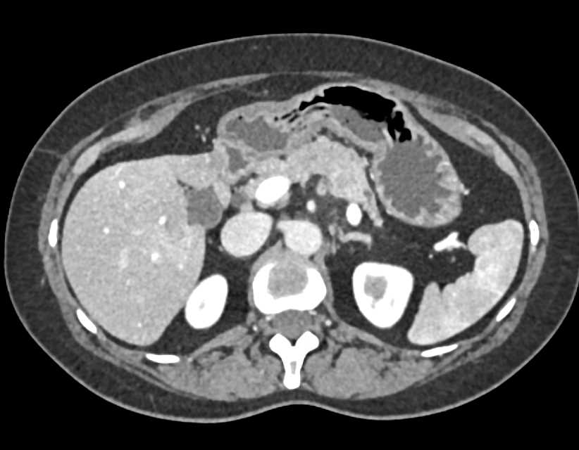 Pancreatic Neuroendocrine Tumor (PNET) Body of the Pancreas with Liver Metastases - CTisus CT Scan