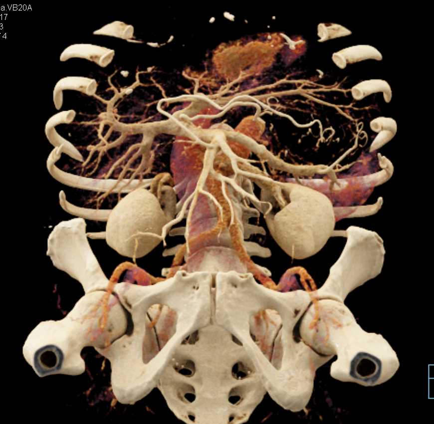 Cinematic Rendering (CR) Mapping of Pancreas and Mesenteric Arcade - CTisus CT Scan