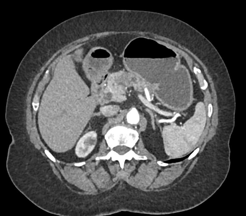 Pancreas Adenocarcinoma - CTisus CT Scan