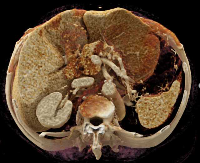 Intraductal Papillary Mucinous Neoplasm (IPMN) Pancreas - CTisus CT Scan