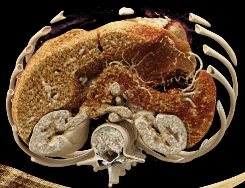 Autoimmune Pancreatitis or AIP - CTisus CT Scan