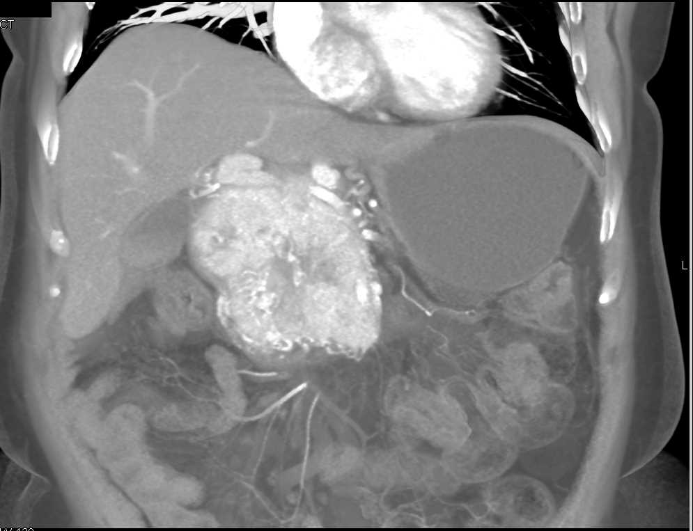 Neuroendocrine Tumor Pancreas - CTisus CT Scan