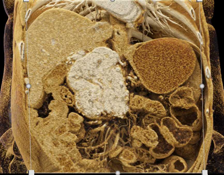 Neuroendocrine Tumor in the Head of the Pancreas - CTisus CT Scan