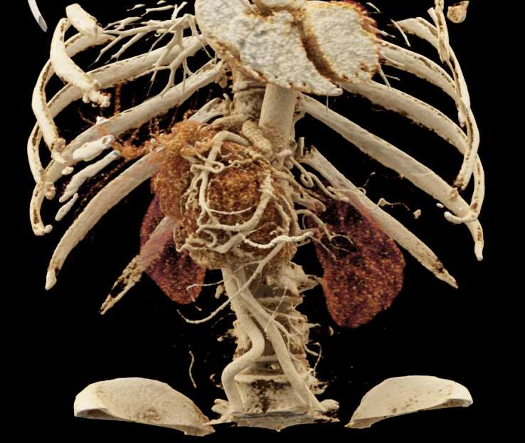 Neuroendocrine Tumor Pancreas with Arterial and Venous Involvement with Cinematic Rendering - CTisus CT Scan