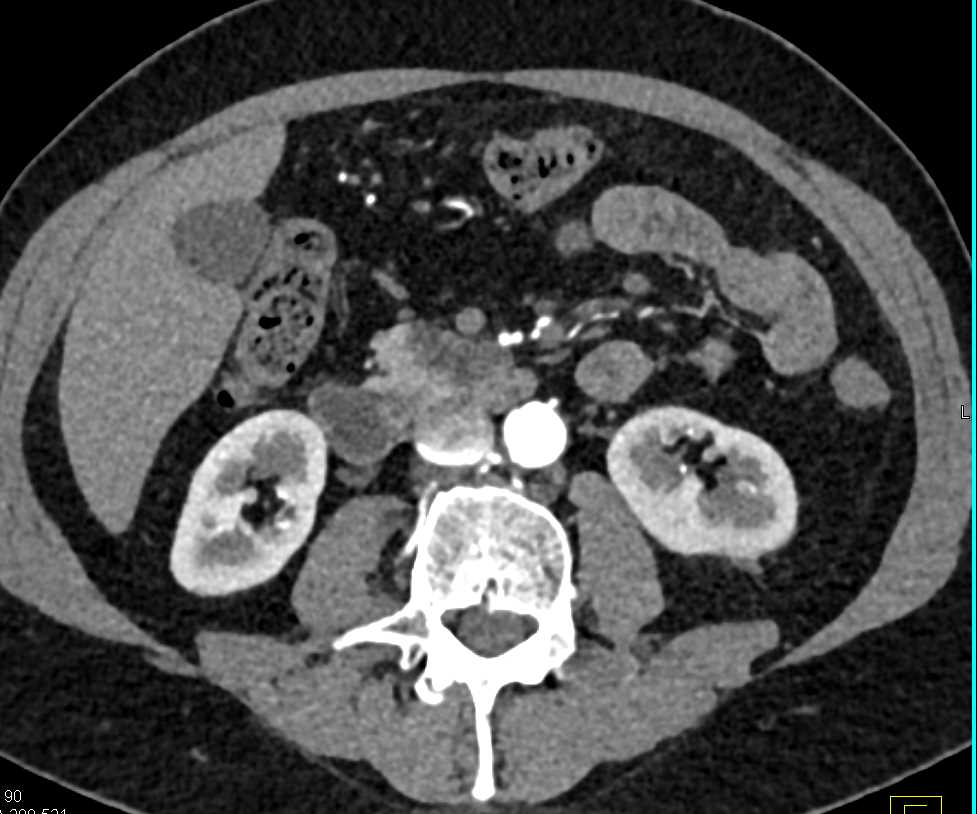 Focal Fat in the Head of the Pancreas - CTisus CT Scan