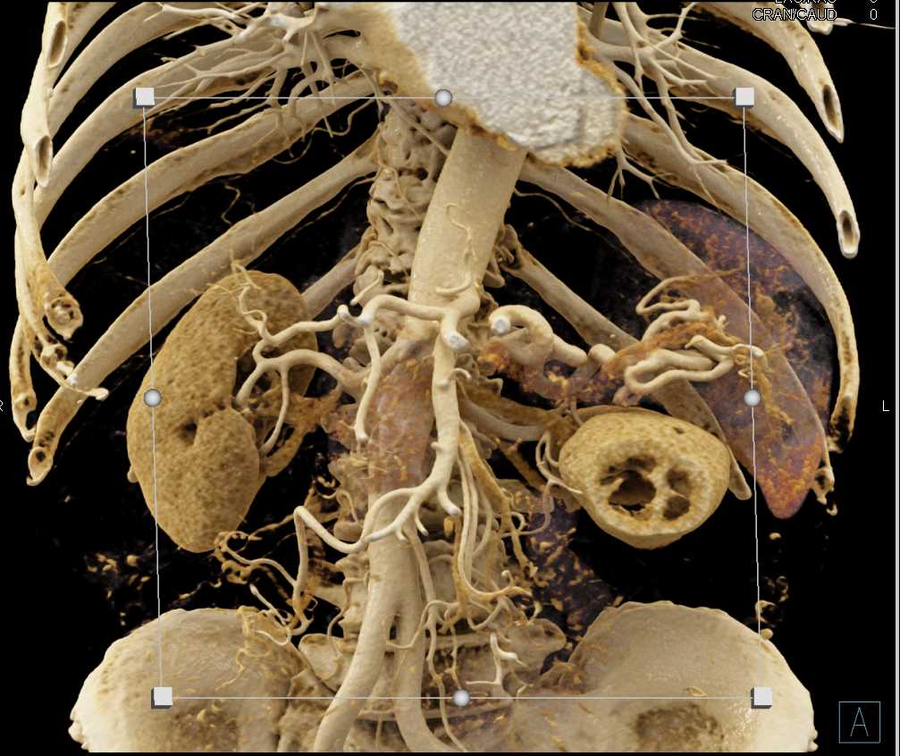 Vascular Mapping of the Pancreas with Cinematic Rendering - CTisus CT Scan