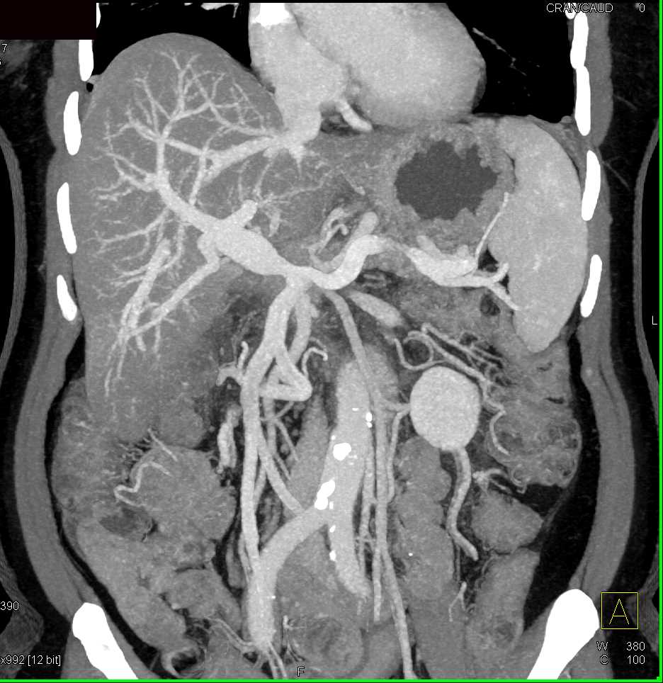 Infiltrating Pancreatic Cancer Involving the PV/SMV and the Celiac and Superior Mesenteric Artery (SMA) - CTisus CT Scan