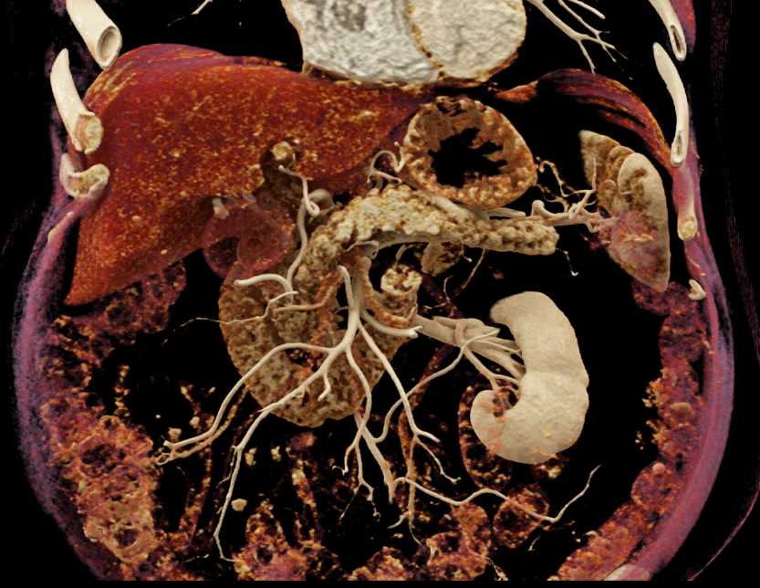 Normal Texture of the Pancreas with Cinematic Rendering - CTisus CT Scan